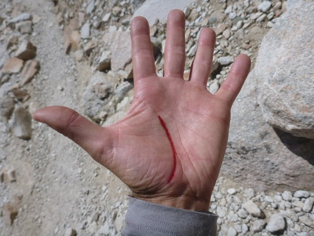 An injury on the JMT.